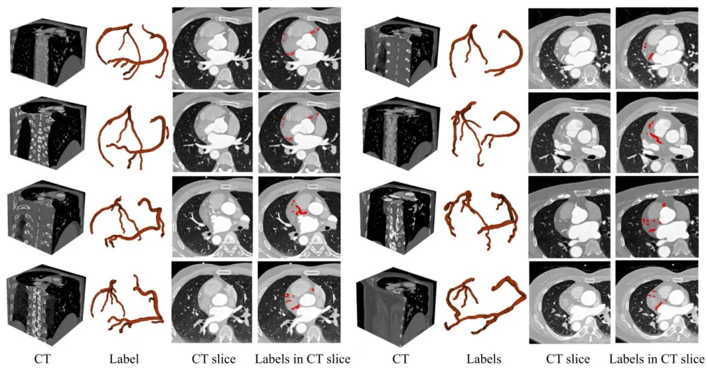 Önerilen ImageCAS veri kümesindeki CT görüntüleri, etiketleri, CT dilimleri ve CT dilimlerindeki etiketlerin dahil olduğu örnekler
